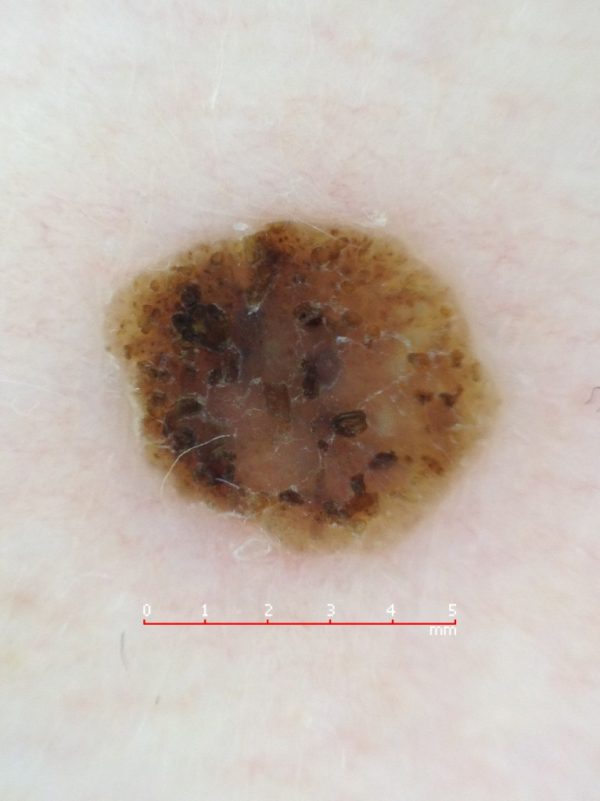queratosis-seborreica-didac-barco