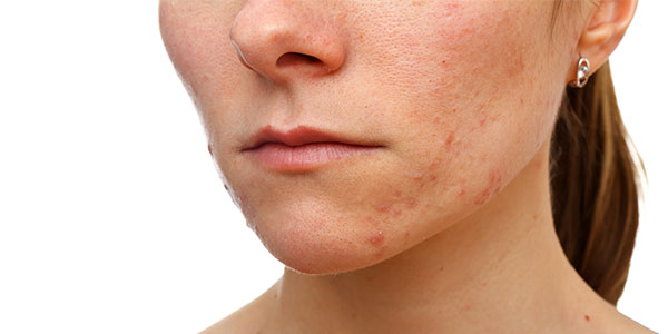 cicatrices-de-acne-tratamiento