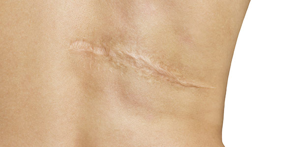 cicatrices-hipertroficas-queloides-laser-KTP-