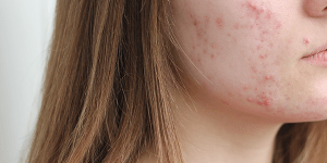 acne-hormonal-mujer-didac-barco