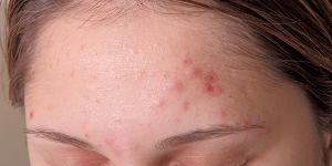 tratamiento-acne-laser-ktp