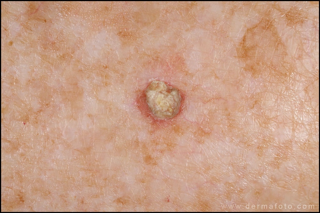 Dermatitis seborreica - Didac Barco