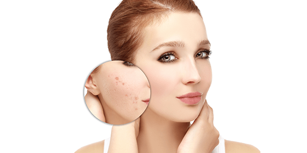 tratamiento-cicatrices-acne-punch