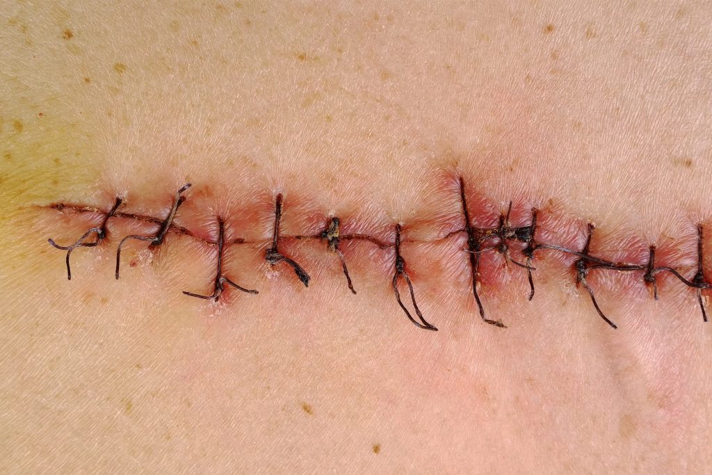 cicatrices con laser de colorante pulsado