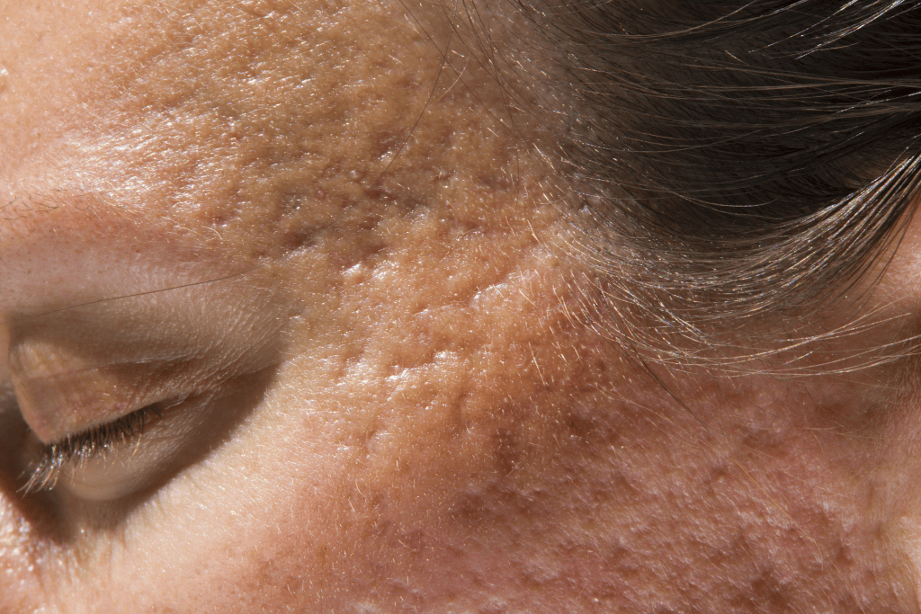 Acne scars Dr. Didac boat
